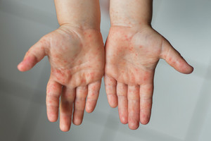 thumbimg